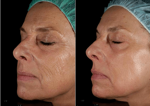 Rajeunissement au laser avant après