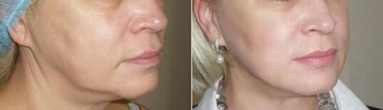 Photo après avoir appliqué la procédure