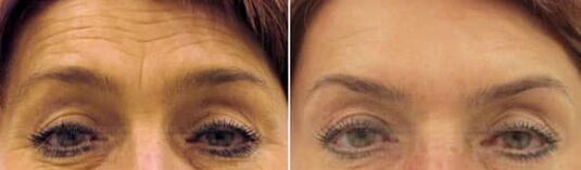 Rajeunissement du champ du front