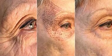 photos avant et après le rajeunissement de la peau au plasma